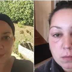Comparaison avant/après : visage normal puis visage gonflé et rouge, signe d'une allergie teinture cheveux.