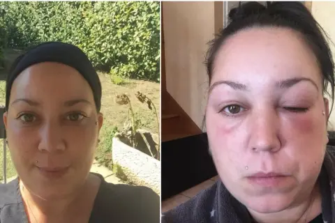 Comparaison avant/après : visage normal puis visage gonflé et rouge, signe d'une allergie teinture cheveux.