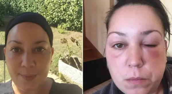 Comparaison avant/après : visage normal puis visage gonflé et rouge, signe d'une allergie teinture cheveux.