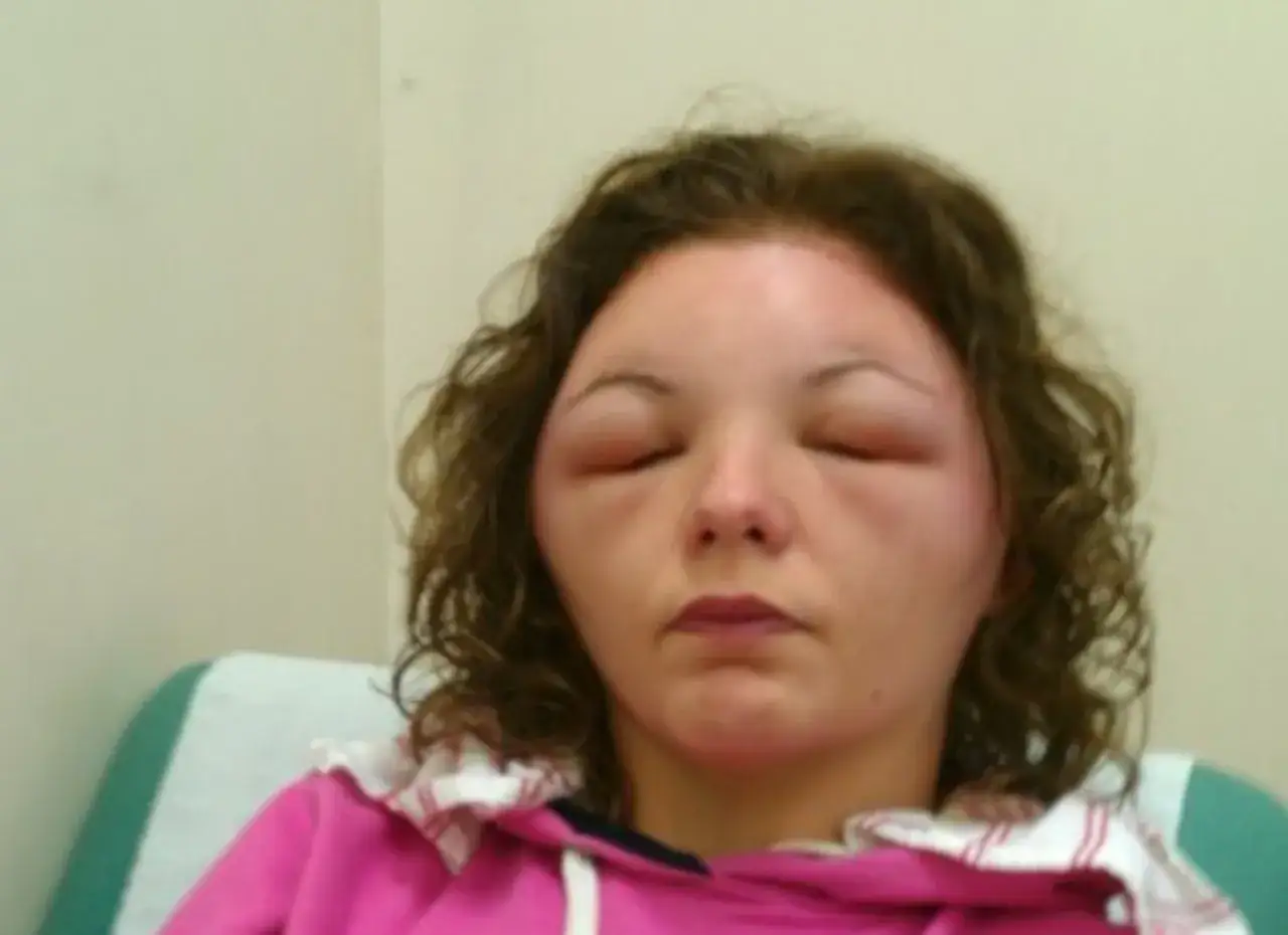 Visage gonflé suite à une allergie teinture cheveux. Les paupières sont très enflées, rendant la vision difficile.