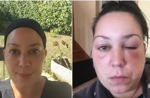 Réaction allergique à une coloration capillaire - que faire ?